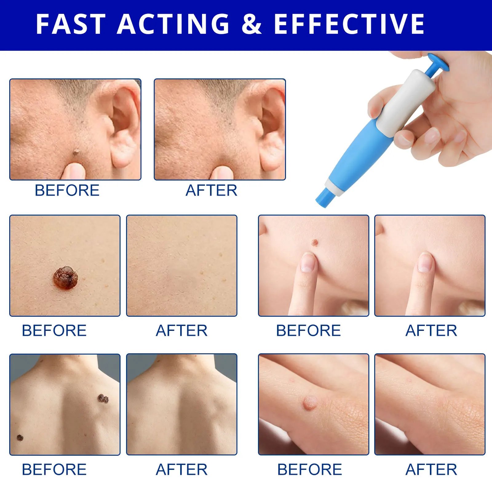 Skin Tag Remover Kit: A Safe and Effective Solution