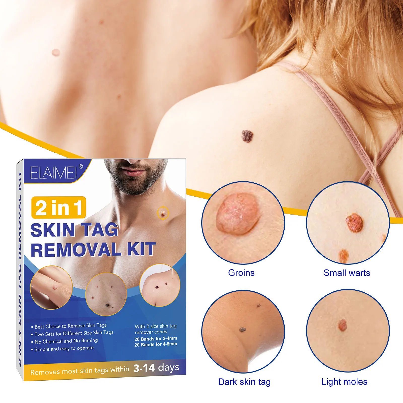 Skin Tag Remover Kit: A Safe and Effective Solution