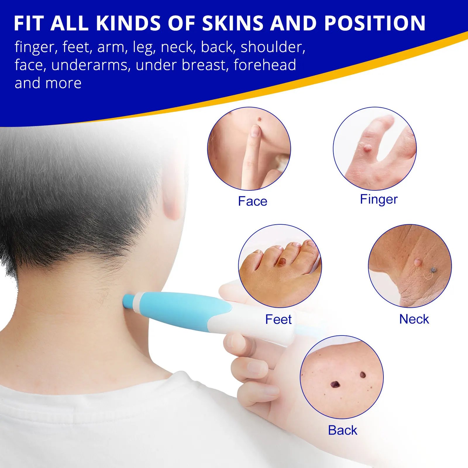 Skin Tag Remover Kit: A Safe and Effective Solution