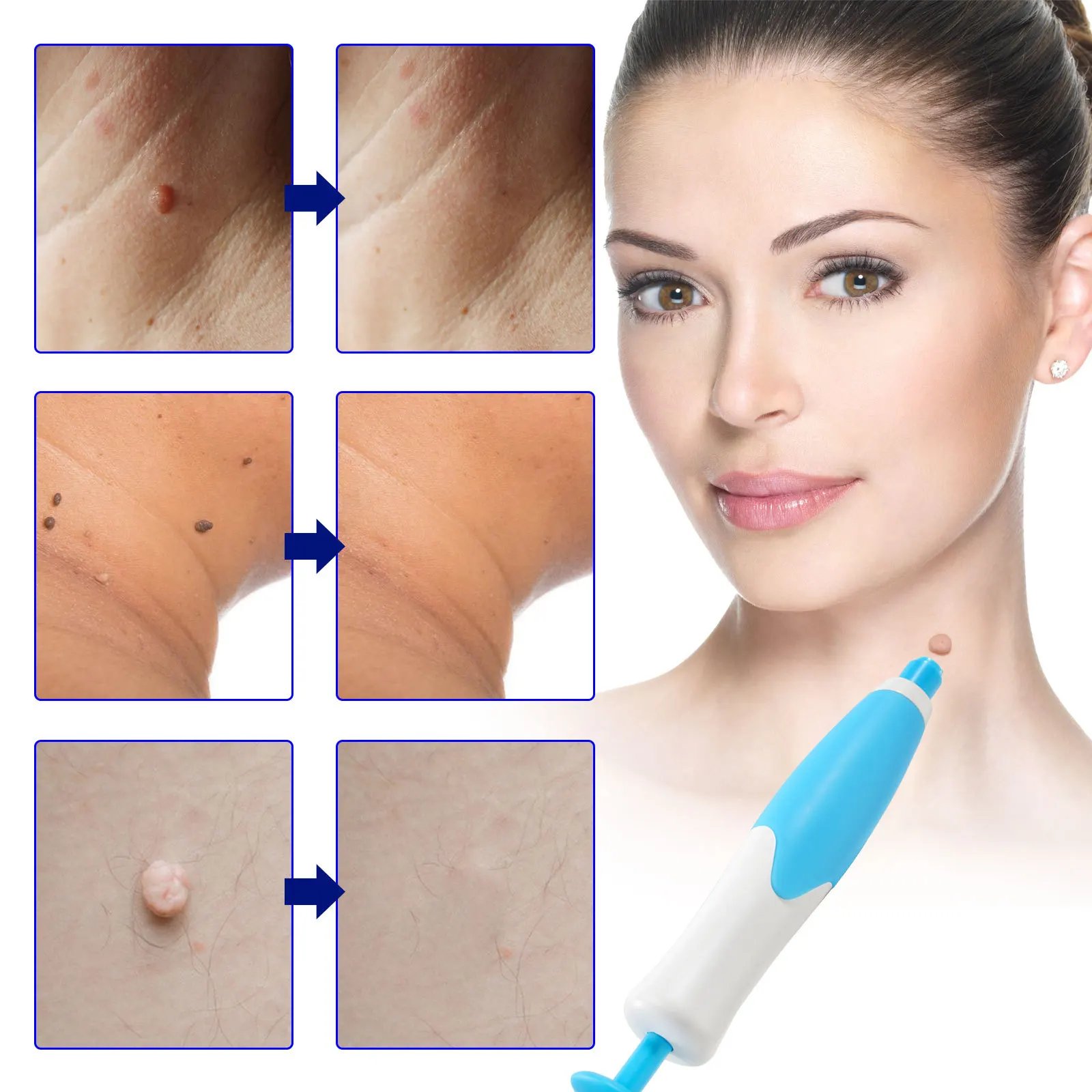 Skin Tag Remover Kit: A Safe and Effective Solution